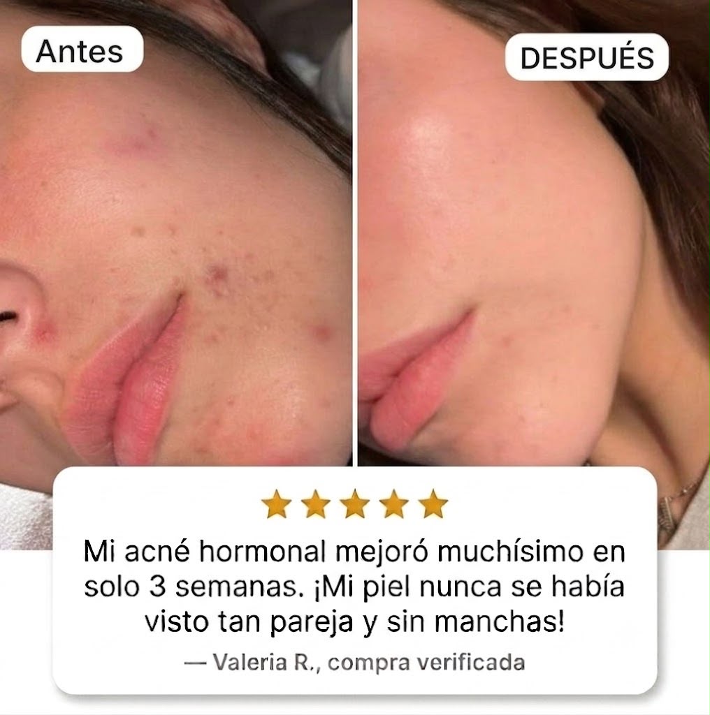 Suplemento Anti-Acné Hormonal Vitaluxe