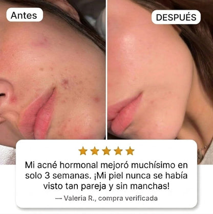 Suplemento Anti-Acné Hormonal Vitaluxe